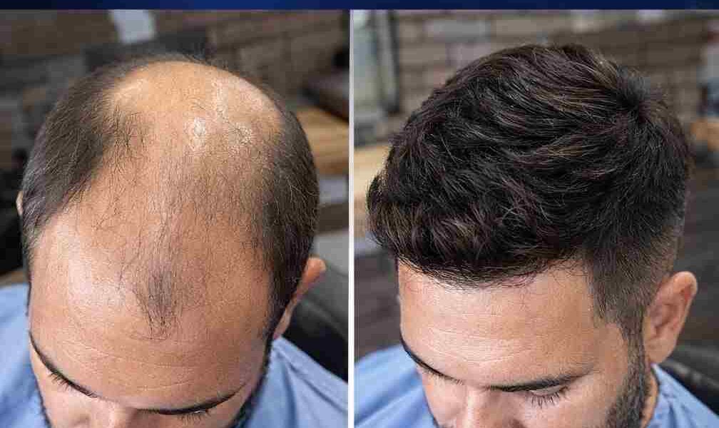 prótese capilar em Divinópolis MG