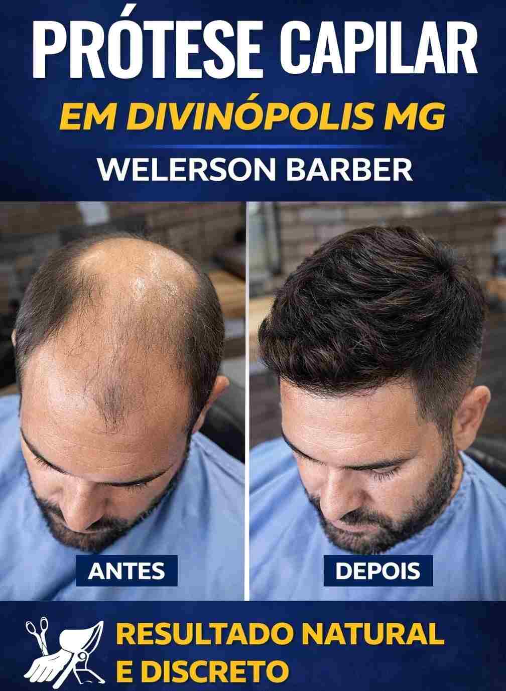 prótese capilar em Divinópolis MG